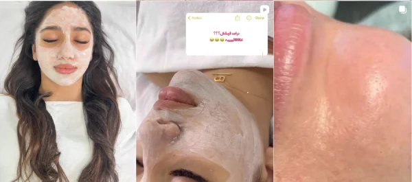 گالری تصاویر پاکسازی و فیشیال پوست هانیه گرگان 3