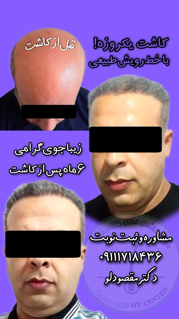 گالری تصاویر کلینیک کاشت مو هیرکان خزر گلستان گرگان 1