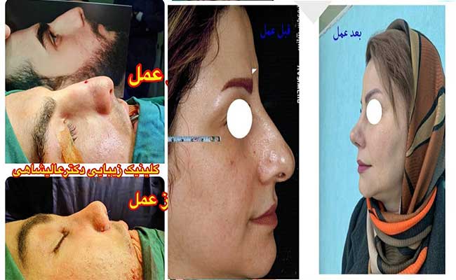 هزینه جراحی بینی دکتر عالیشاهی گرگان همراه نمونه کار